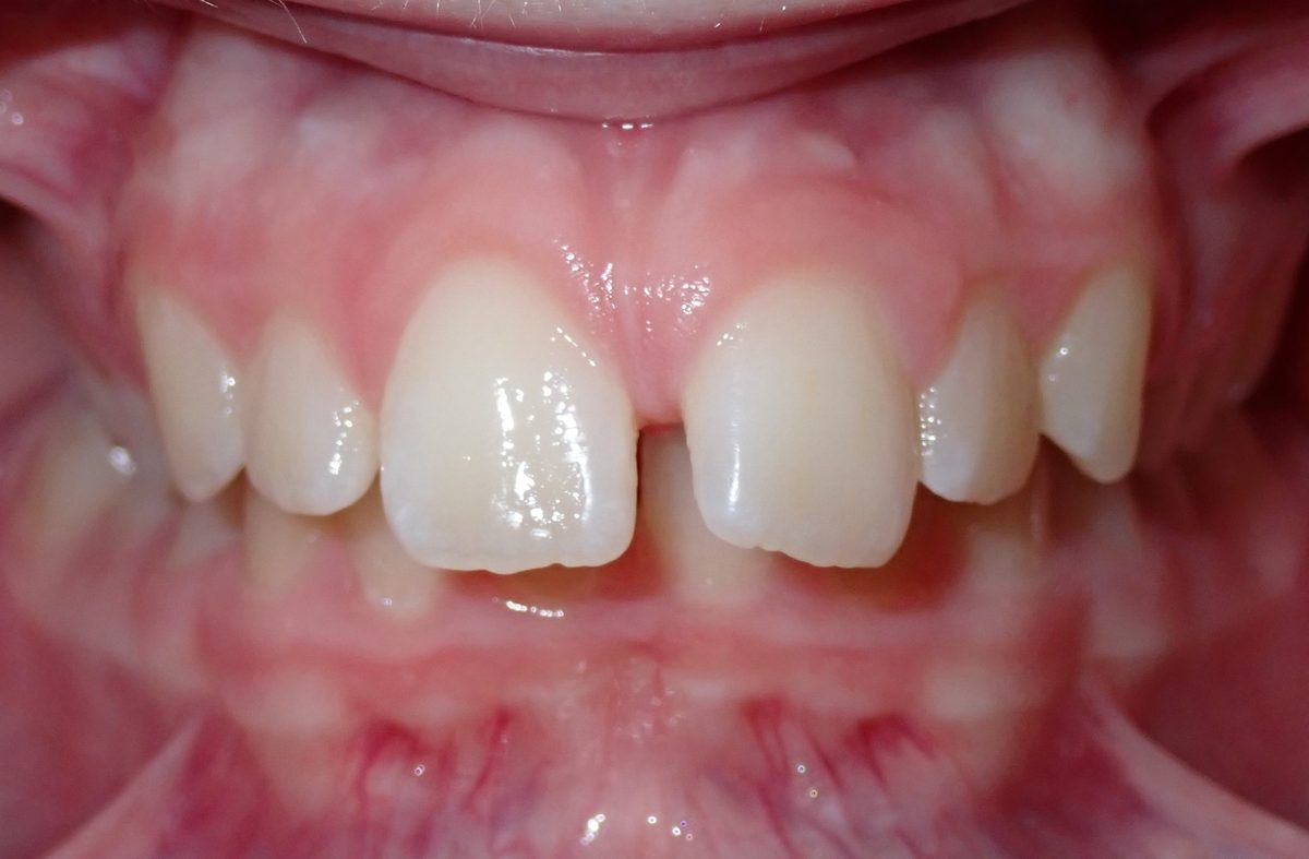 Vivid Smiles patient case 1 before and after treatment comparison before